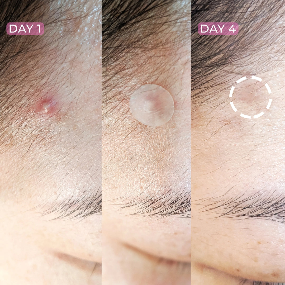 Hydrocolloid Blemish Patch 36 Ct P345295